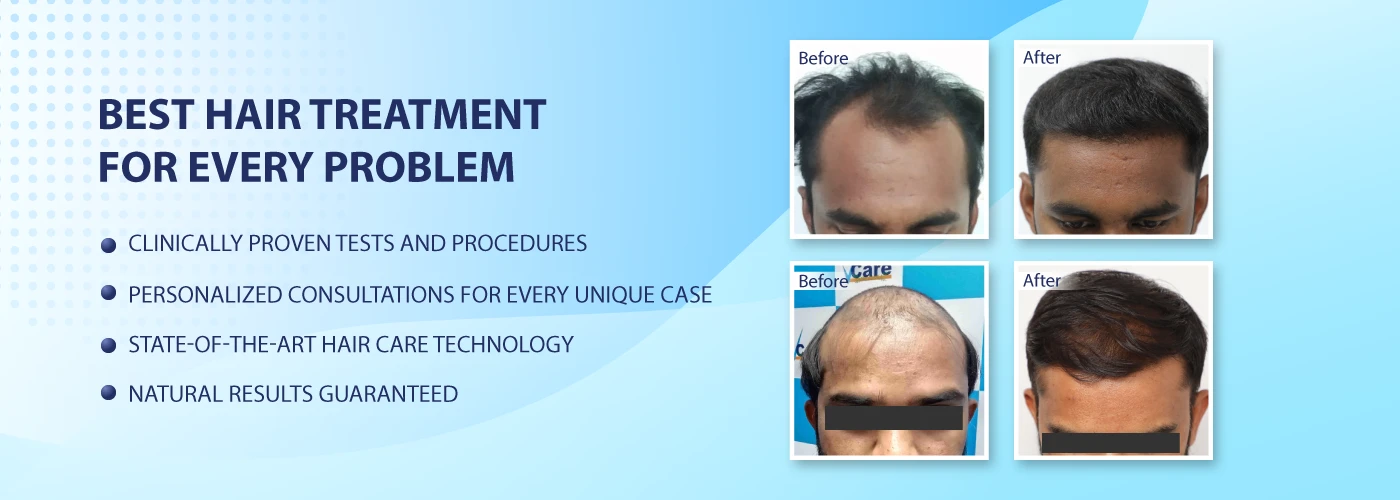 Best Hair Clinic in India Hair Loss Treatment Hair Clinic